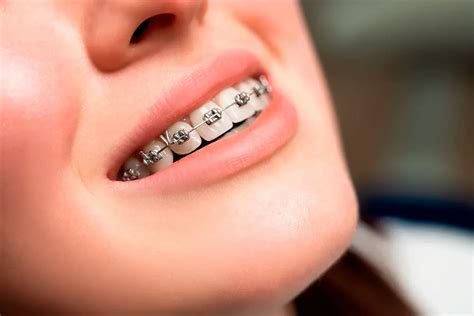 precio de brackets metalicos en argentina|cuanto cuesta un bracket.